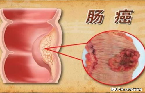 肠息肉是癌症的 种子 如何有效预防息肉发生