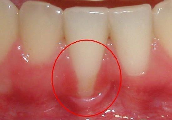牙龈在什么位置图片什图片