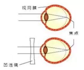 希玛眼科屈光专家 近视的人老了以后就不会得老花眼了吗 