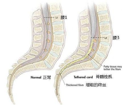 儿童 脊髓栓系综合征 是什么 怎么治疗