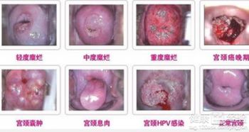 引起宫颈糜烂的原因