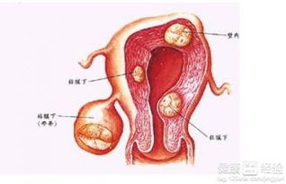 子宫肌瘤的调养方法你了解吗