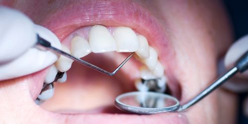 老是容易牙酸,牙齿敏感疼痛,怎么处理 需要看牙医吗 