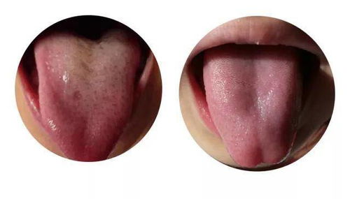 如何清理舌苔表面污物