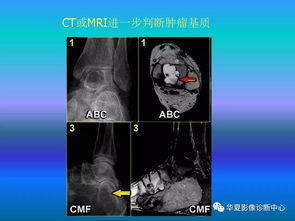 骨肿瘤 肿瘤样病变的影像诊断及策略