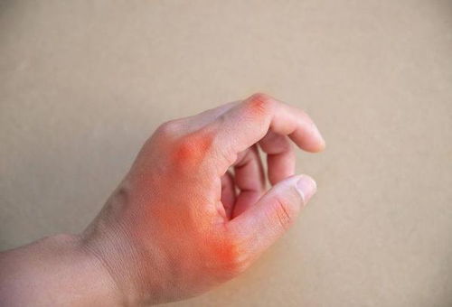 手指关节总是疼痛,或与这5个原因有关,问题可大可小,需重视
