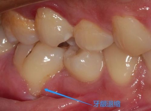 孩子的牙齿不整齐有什么危害,有必要矫正吗