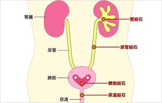 输尿管下段结石怎么看，如何判断自己有泌尿系结石