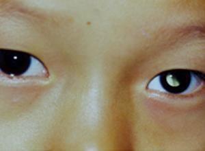 瞳孔变白的治疗方法