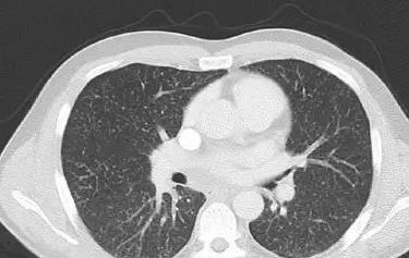 双肺多发微小结节是什么原因 医生 这四种原因最常见