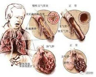 慢支的内幕让人毛骨悚然,支气管炎赶紧用这几招晚了来不及