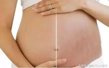 预防妊娠纹 如何预防妊娠纹