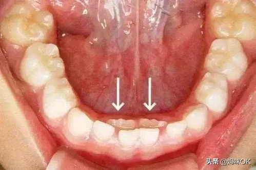 娃的牙齿遇到这种情况,一定尽快找医生确认处理了