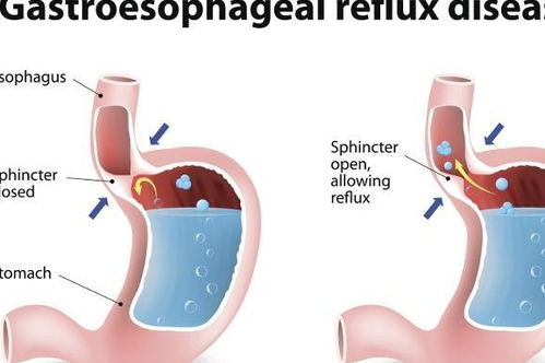 出现反酸,腹胀是浅表性胃炎还是胃食管反流