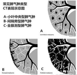 关于 肺气肿 的一些概念,需要熟悉 结合CT