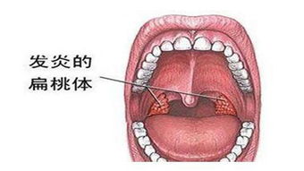 喉咙肿怎么办(喉咙肿怎么办,吞咽疼痛)