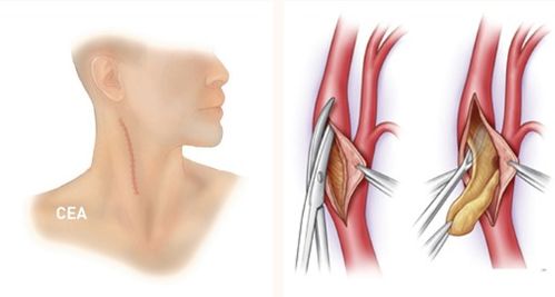 颈动脉内膜剥脱术 CEA 清除颈动脉垃圾,远离脑梗塞