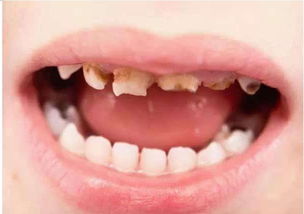 乳牙，乳牙有什么作用
