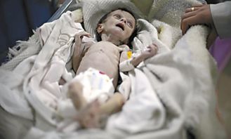 骨瘦如柴 面若死灰 一张心酸照片背后是饥饿的叙利亚儿童