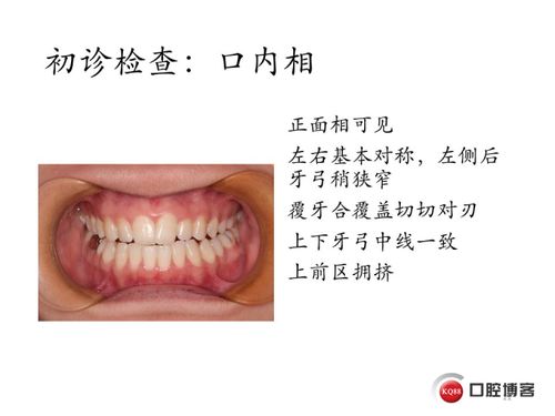 2020 1 一例牙齿不齐的矫正