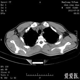 肺部CT