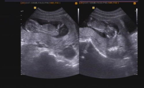我的龙凤胎猪宝宝五个月啦,分享试管之路和惊险的保胎过程