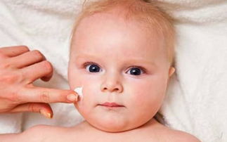 出生婴儿湿疹抹什么药,新生婴儿湿疹怎么治疗