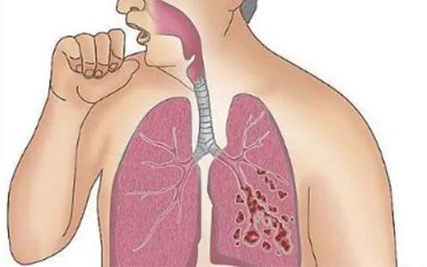 气管炎哮喘 支气管炎是不是哮喘