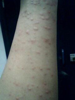这是不是荨麻疹,过上一两个月就会出现,过不了多久就消失了,怎么治疗好 