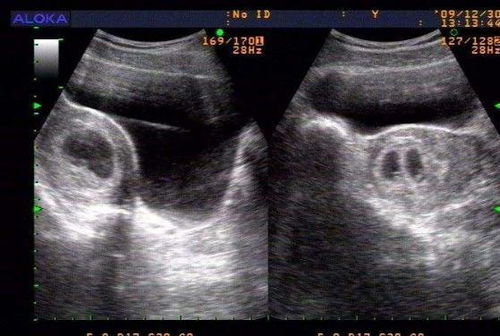 50天女孩胎囊图片孕囊图片