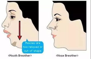 什么是口呼吸