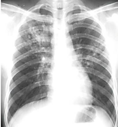 肺结核增殖病灶 斗图表情包大全 - 与 肺结核增