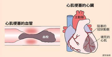 为什么会得心肌梗塞 