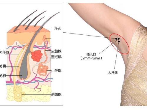 夏天可以做腋臭手术吗 贵阳很多朋友都在寻找治疗腋臭正规医院