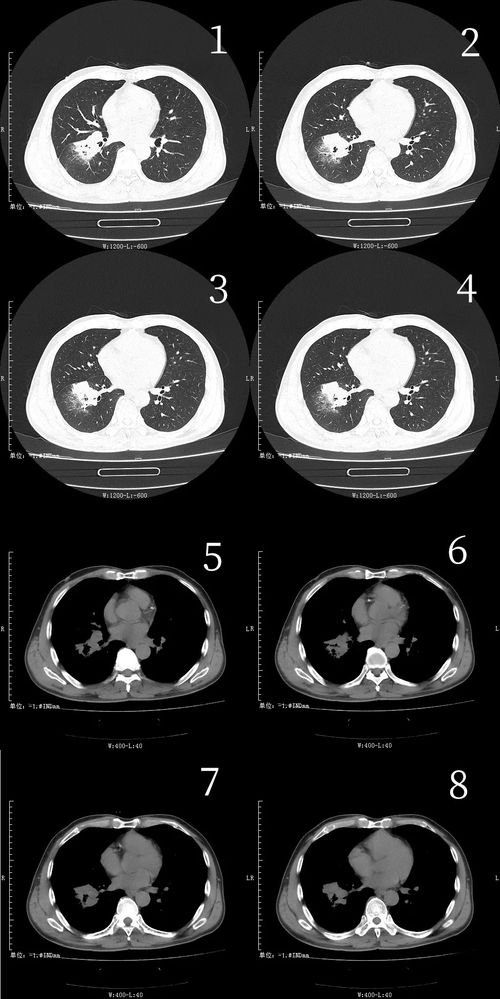 是炎性肿块还是肺癌 这 16 个病例让我们来明察