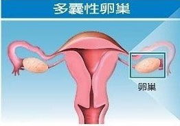 多囊卵巢综合症能治好吗，多囊卵巢可以根治吗
