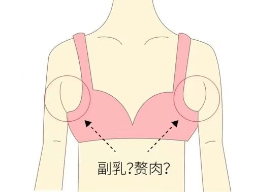 产后副乳多一坨赘肉,影响的只是美观 不 危害可多