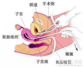 包头无痛人流要多少钱？怀孕不想。。