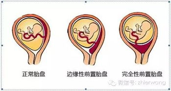 宝宝离奇死于腹中,警惕 这种低级错误千万要注意 