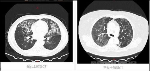 CT检查变 白肺 不是因为新冠,却是因为消毒 原来事情是这样的