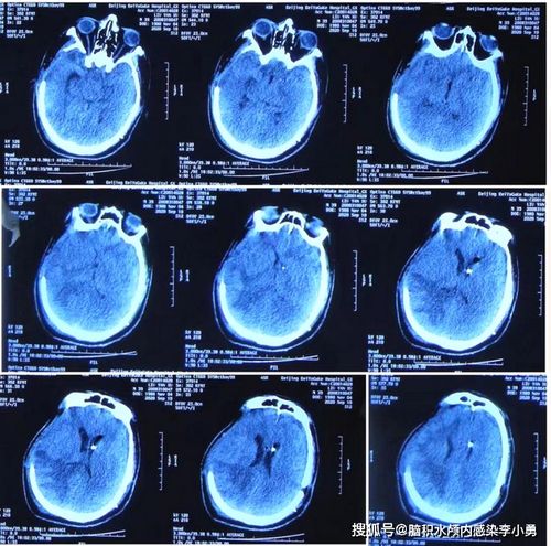 脑外伤后 硬膜下积液 脑膨出 ,两次积液引流手术 一次腰大池引流治疗无效