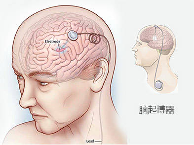 田卫东医生 得了帕金森病是吃药好还是手术好