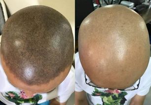头发稀疏 脱发 6种方法补救方法对比详解