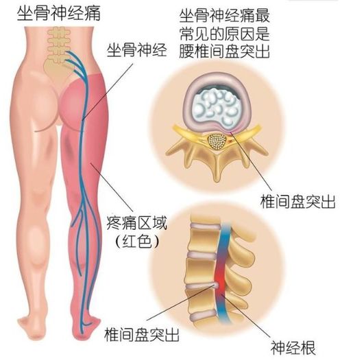 坐骨神经痛怎么医治 坐骨神经痛怎么治最快又省钱 