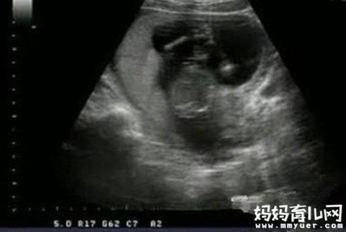 怀孕3个月胎儿b超图(三个半月B超图怎么辨男女)