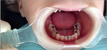 孩子几个月长牙齿,孩子几个月长牙齿正常