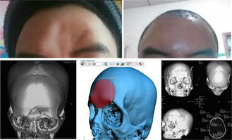 清华大学颅骨修补整形美容标准化手术介绍 附 典型图片