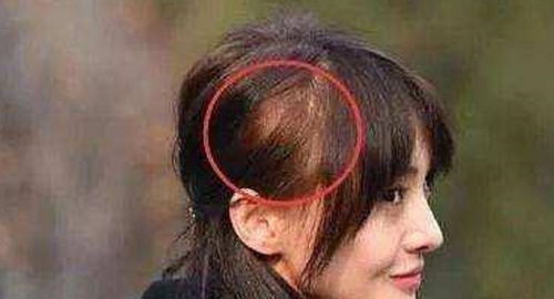 发量少还掉发的女生,切记不要留这3款发型,难看发际线还会上移