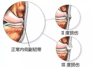 膝盖好不好,看上下楼梯的姿势,赶紧对照自查