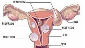 多发性子宫肌瘤的治疗方法有哪些啊